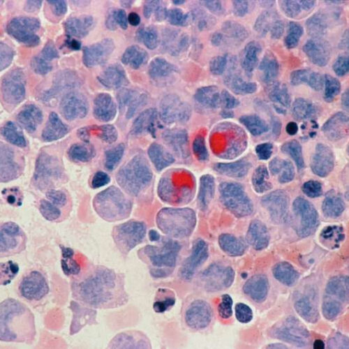 Locking leukemia’s cellular escape hatch