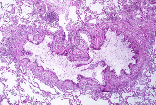 Why do some asthma patients respond poorly to treatment?