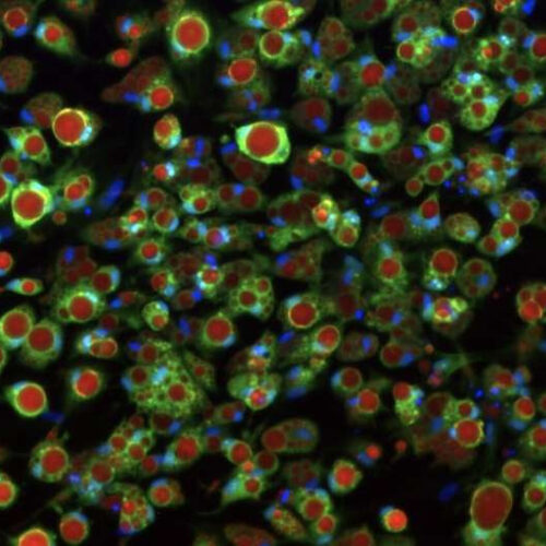 Lab-grown fat cells help scientists understand type 2 diabetes