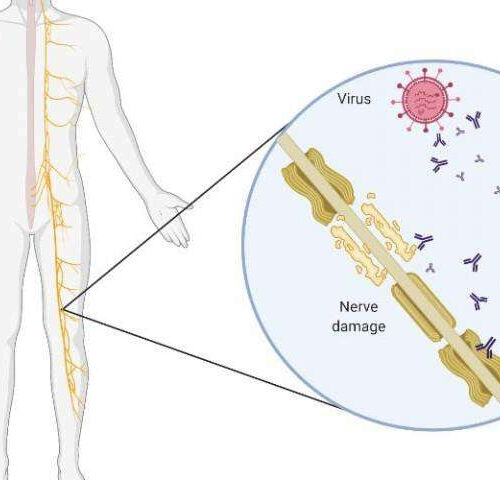 Researchers identify rise in Guillain-Barré syndrome following AstraZeneca vaccine