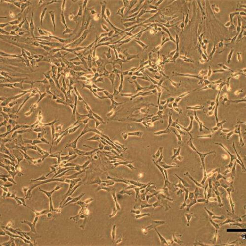 First successful treatment of severe pulmonary hypertension with umbilical cord stem cells