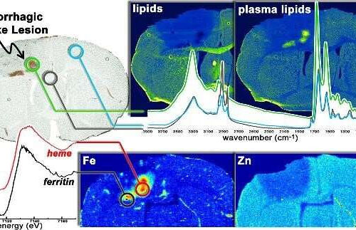 Cutting-edge imaging yields new insights into stroke