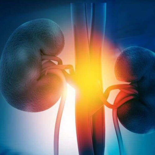 Tirzepatide improves kidney outcomes in T2DM with increased CV risk