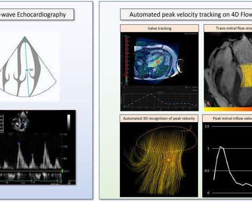 Cutting-edge 4D flow MRI scans could revolutionize blood flow assessment in the heart