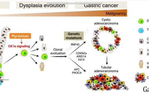 Study reveals how gastric cancer forms, suggests preventive treatment