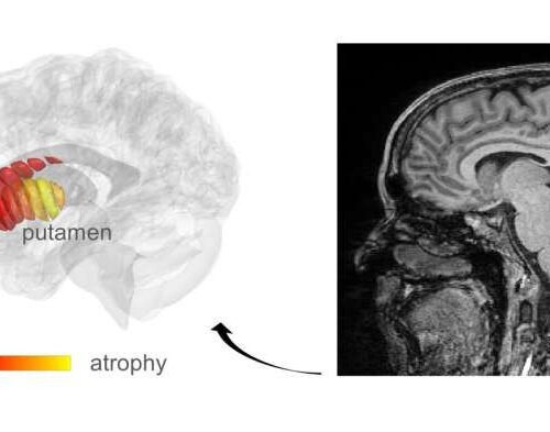 New imaging method could lead to diagnosis of early stage Parkinson’s disease