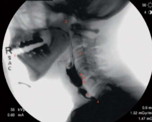 New guidelines laid out to standardize swallowing fluoroscopy