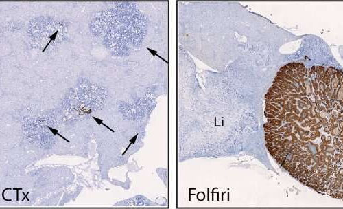 Scientists unravel the key to colon cancer relapse after chemotherapy