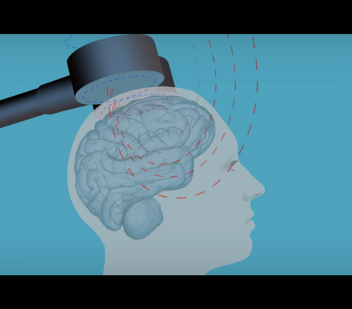 Why brain stimulation should not be overlooked as an antidepressant treatment for older adults