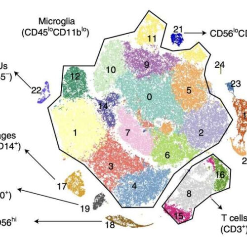 Study unveils pro-inflammatory interactions in drug-resistant epilepsy