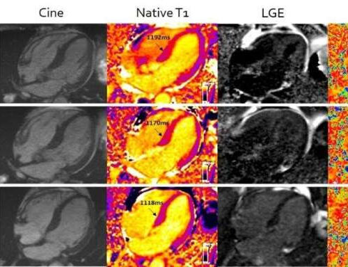 Advanced MRI benefits patients with heart stiffening disease