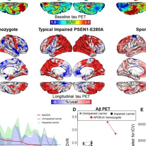 An Alzheimer’s-defying brain offer clues to treatment and prevention of dementia