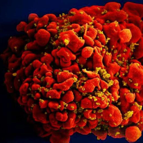 Study shows HIV speeds up body’s aging processes soon after infection