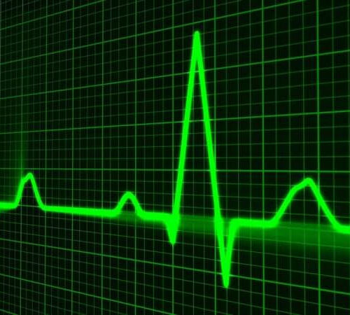 AI + ECG heart trace can accurately predict diabetes and pre-diabetes