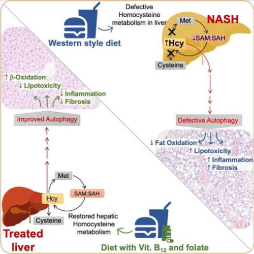 B vitamins can potentially be used to treat advanced non-alcoholic fatty liver disease