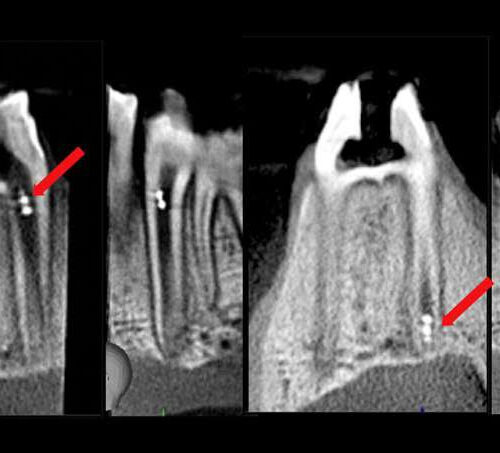 Research applies microrobotics in endodontic treatment, diagnostics