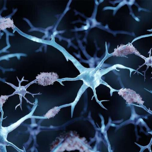 Altered brain connections in early Alzheimer’s disease