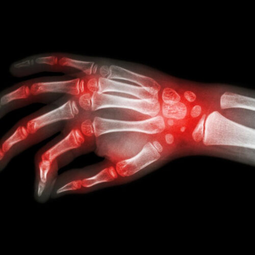 New rheumatoid arthritis drug passes Phase 3 trial, looks to approval