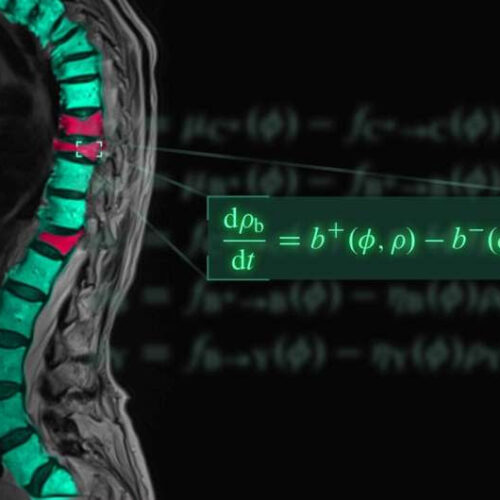 New model can predict best drug combinations for osteoporosis