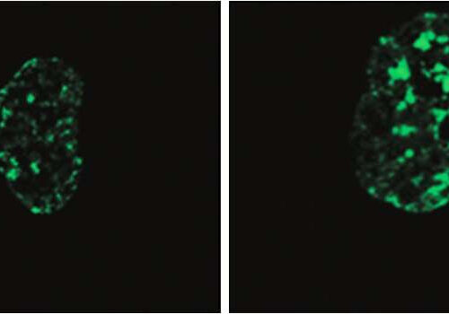 New target identified for treatment of premature aging disease