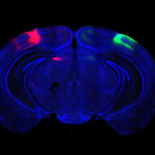 When Alzheimer’s degrades cells that cross hemispheres, visual memory suffers