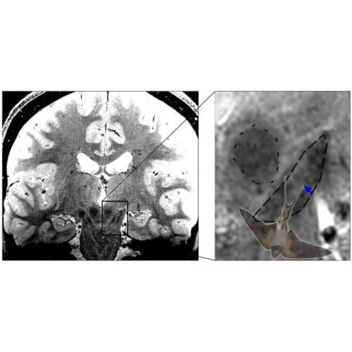 Potential of nigrosome imaging for earlier diagnosis of Parkinson’s disease