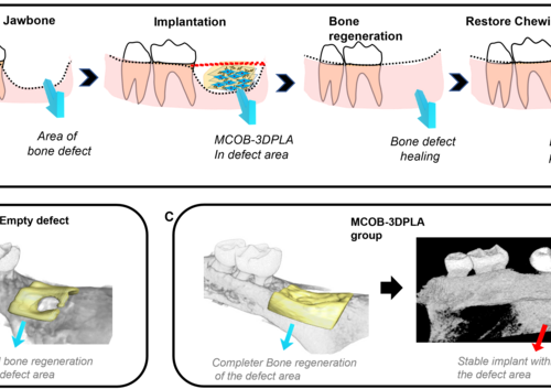 Bone transplant could resolve aging jaw defects