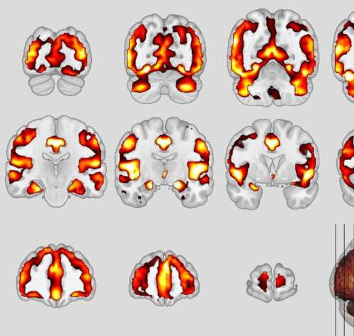 Similarity between schizophrenia and dementia discovered for the first time