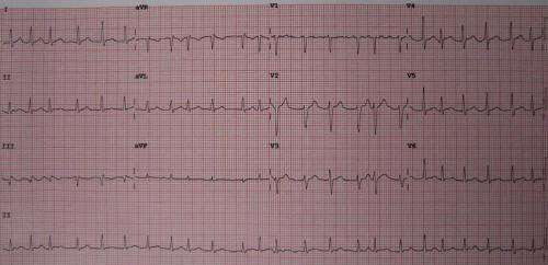 Atrial fibrillation screening using smartphones increases detection and treatment