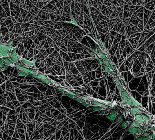 Skin cancer cells harness nerve cell gene to drill through and invade new tissues