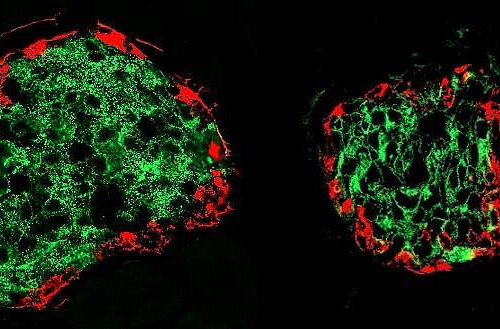 Detecting diabetes before the first symptoms appear