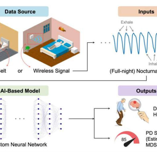 Artificial intelligence model can detect Parkinson’s from breathing patterns