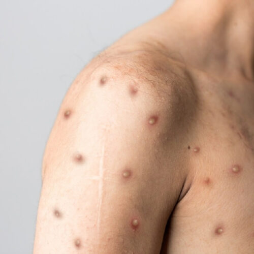 Case series of first 3 monkeypox patients in Massachusetts treated with tecoviromat