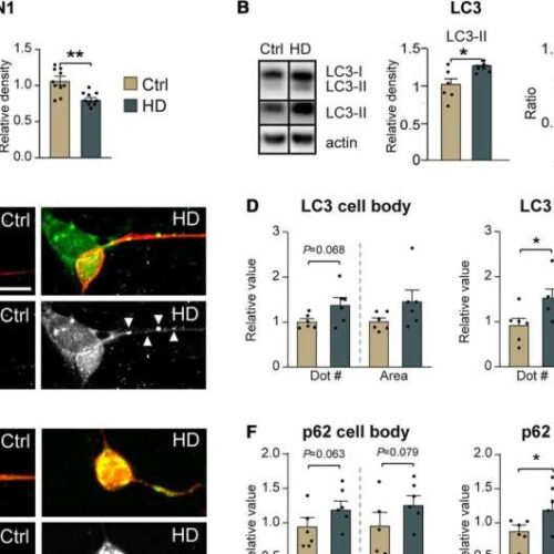 Reprogramming human skin cells into aged neurons to study neurodegenerative disorders