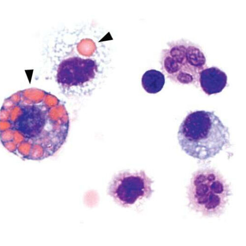 Mechanism discovered that leads to ANCA-associated vasculitis