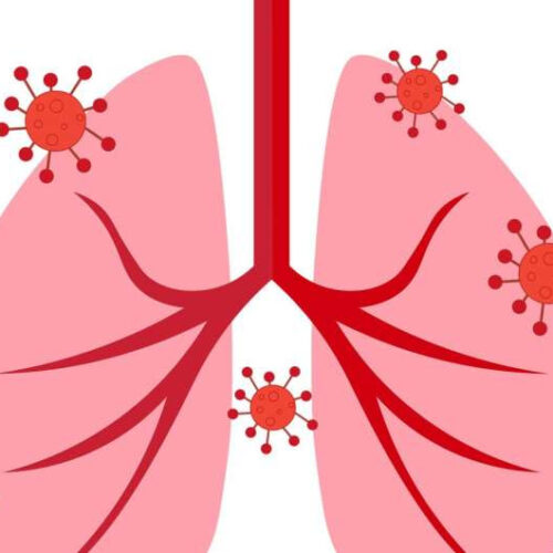 Long COVID-19 may stem from an overactive immune response in the lungs