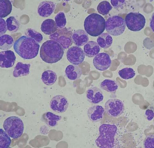 Promising approach to mitigate complications of leukemia treatment