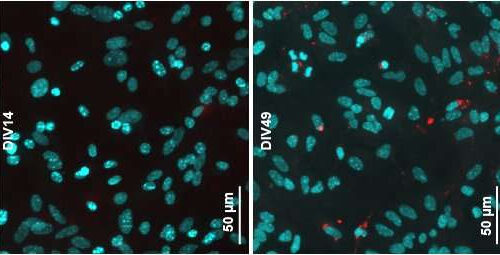 Discovery illuminates how Parkinson’s disease spreads in the brain