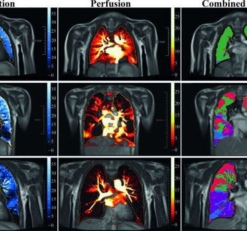 Lasting lung damage seen in children and teens after COVID