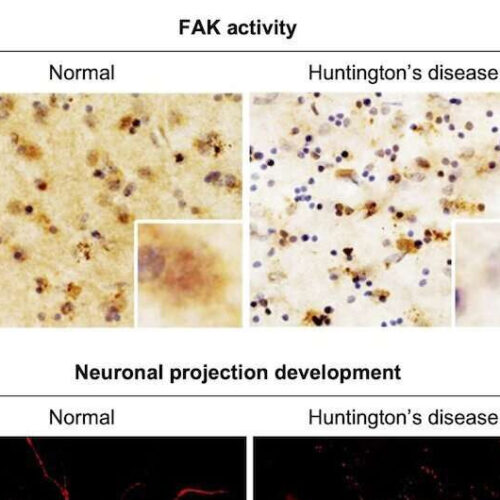 Exploring the causes of brain dysfunction in patients with Huntington’s disease