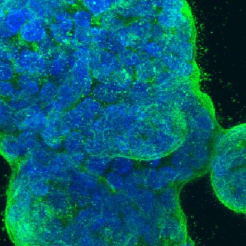 Keeping aggressive cancer cells in check by blocking a protein responsible for repairs
