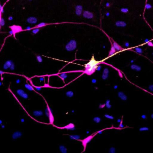 Aged neurons generated directly from skin more accurately model Parkinson’s disease