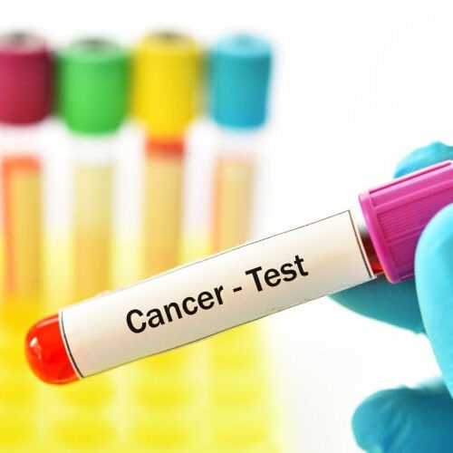 Blood Test That Screens for 50 Cancers Found Promising in Preliminary Study