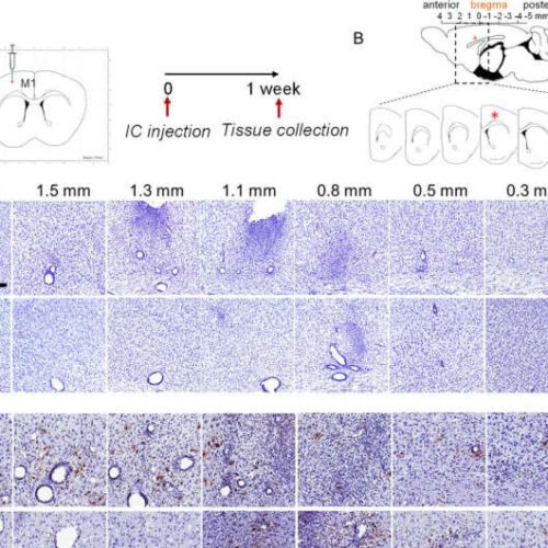 Researchers identify possible treatment target for a type of sporadic ALS