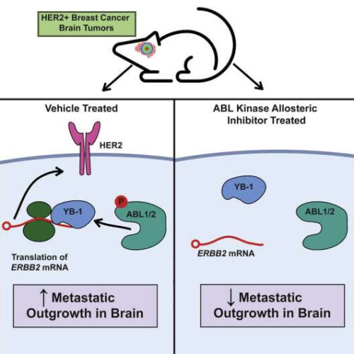 Leukemia drug shows potential against metastatic HER2-positive breast cancer