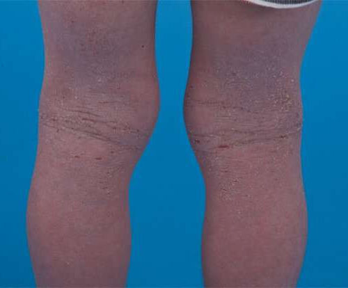 New drug therapy for young children with severe eczema