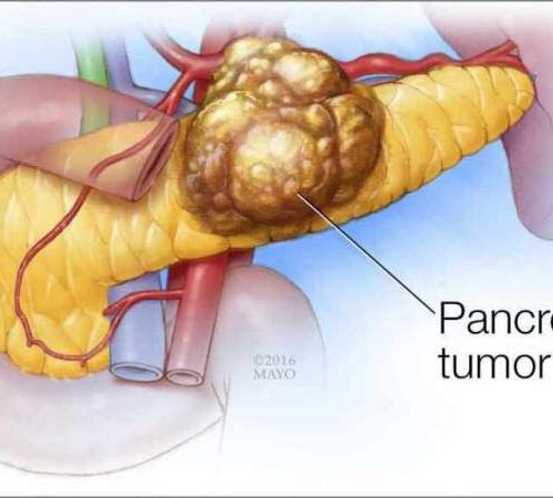 Researchers identify potential gene marker for treating pancreatic cancer