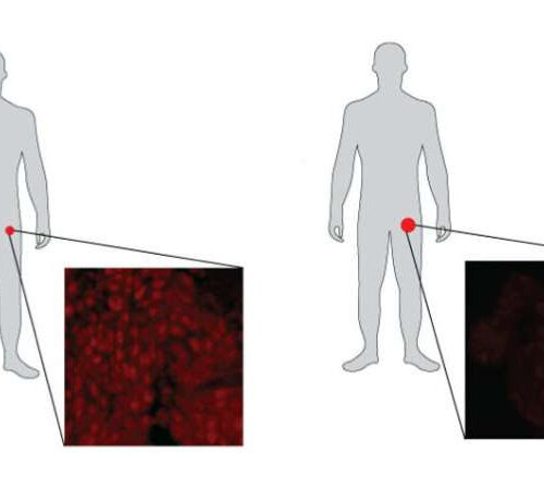 Research suggests commonly used prostate cancer treatment rewires engine of prostate tumors