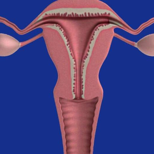 HSD3B1 gene research shows an association between genotype and endometrial cancer