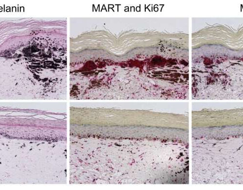 Research shows that DOPA protects against melanoma